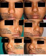 Before After Pictures,Nose job,Rhinoplasty,Delhi
